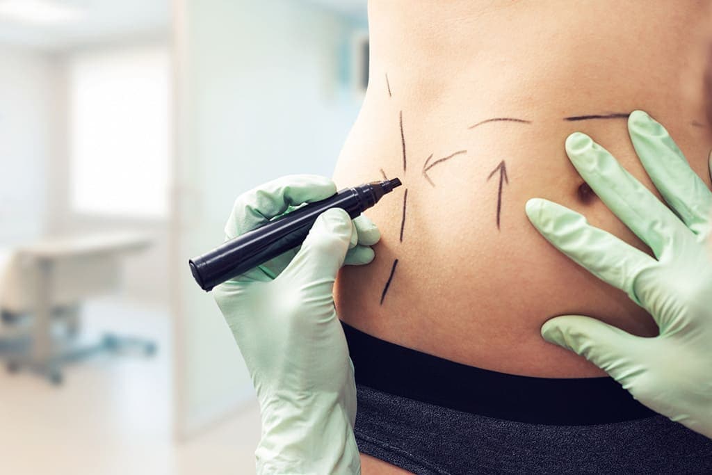 Consórcio para lipoaspiração: um profissional da saúde realiza marcações na barriga de uma mulher, que fará um procedimento estético.