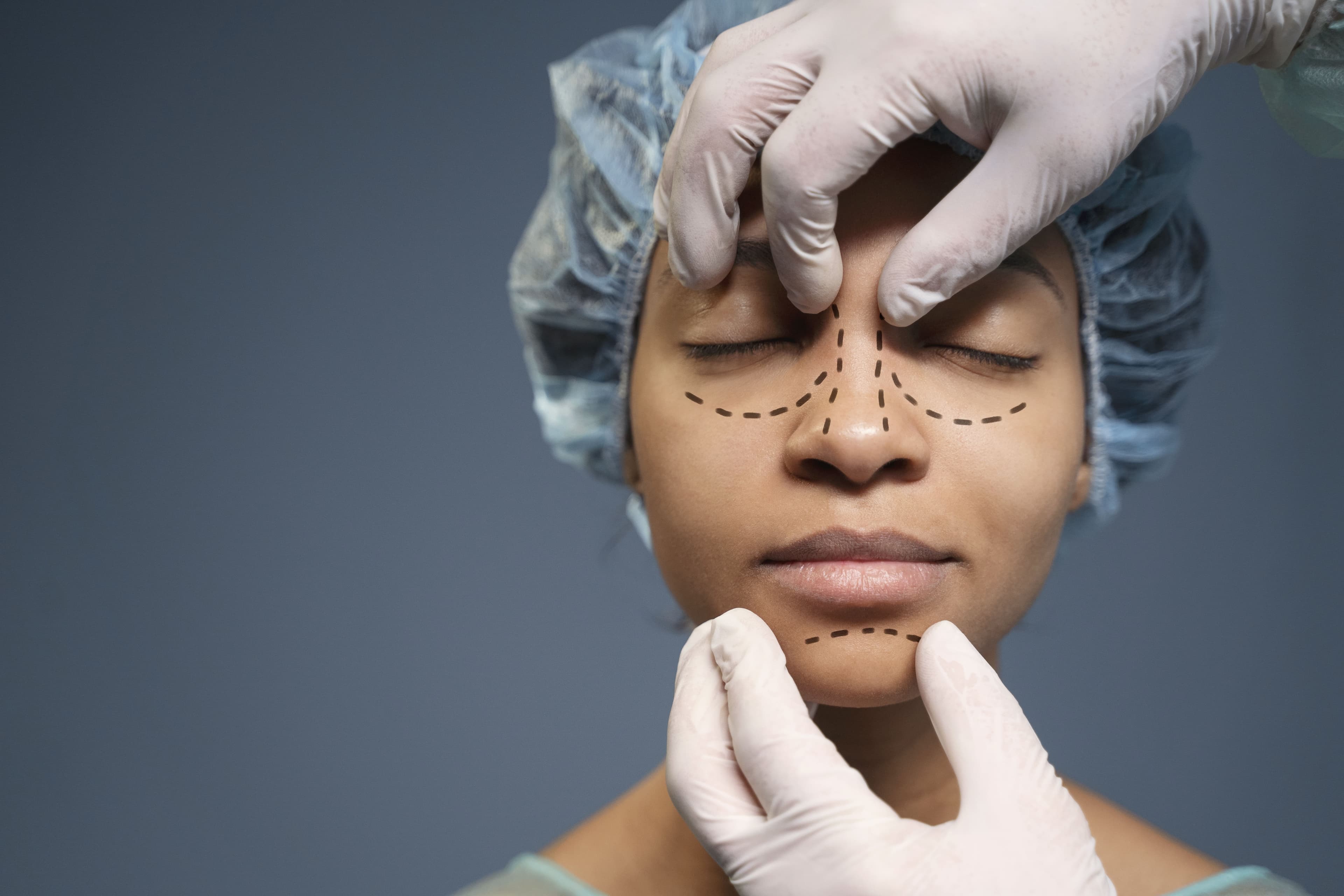 mulher com rosto marcado (empréstimo para rinoplastia)